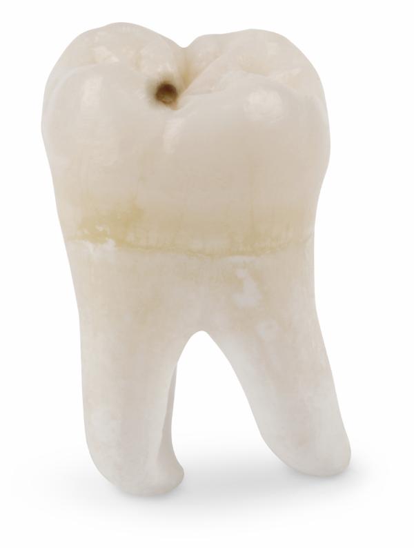 Каковы признаки и симптомы кариеса зубов?